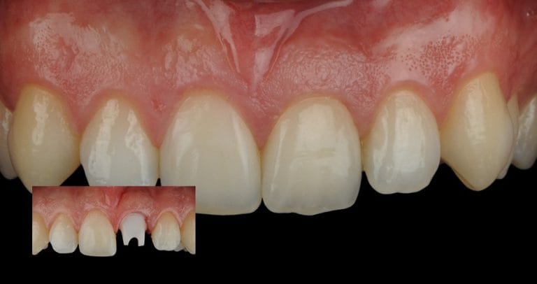 Caso real de implante dental unitario: corona definitiva sobre implante en CIMA Dental
