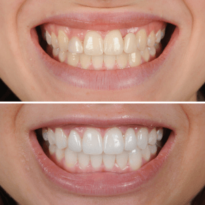 Rehabilitación completa sobre implantes dentales: resultado final en CIMA Dental