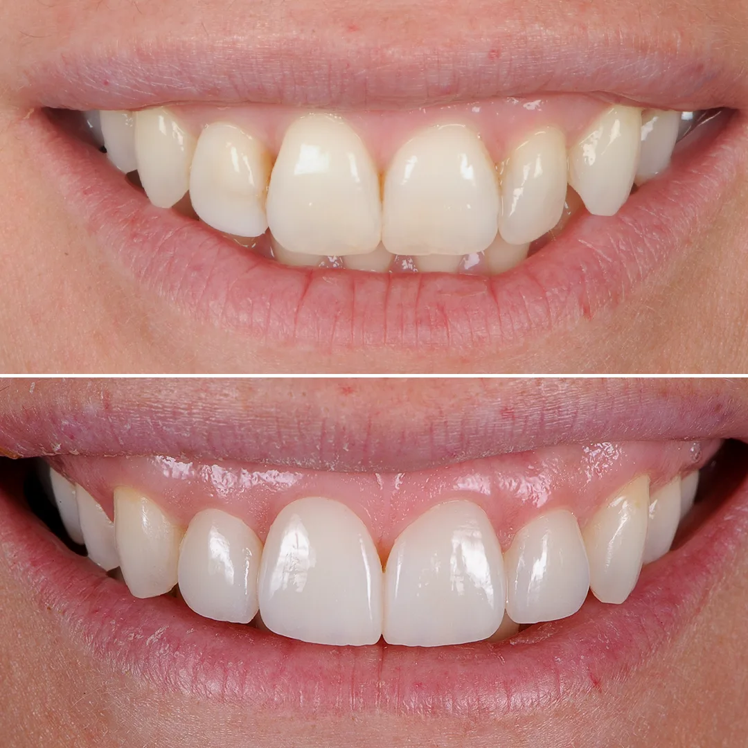 Caso real de carillas de porcelana en CIMA Dental, Madrid