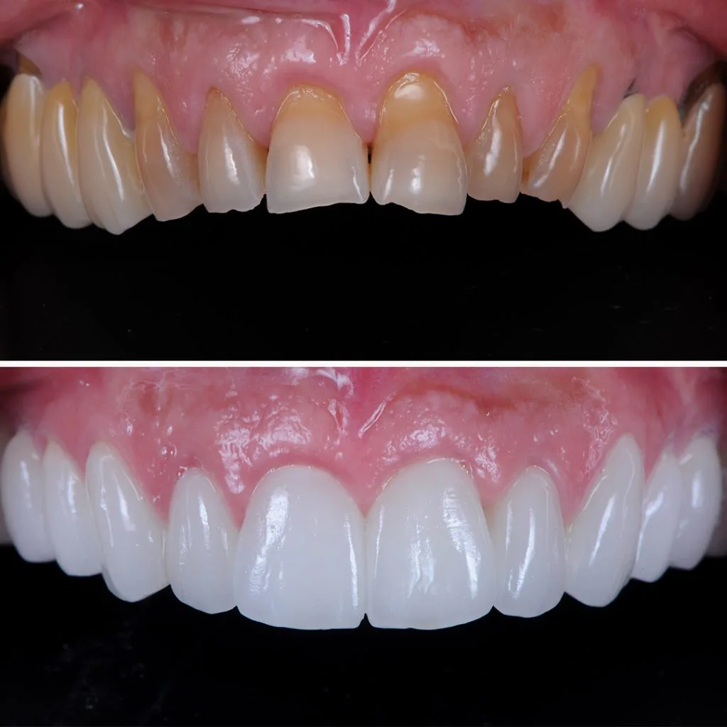 Caso real de carillas dentales de porcelana realizado en CIMA Dental, Madrid
