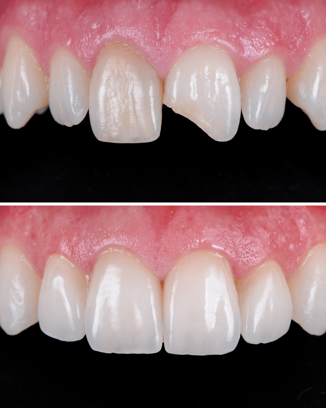 Caso real de carillas de composite en CIMA Dental, Madrid