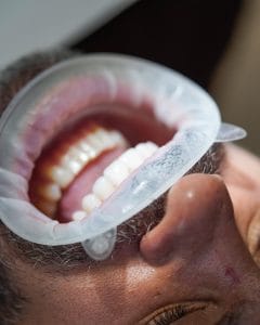 Tratamiento de la bruxismo: revisión en detalle de las mordida en CIMA Dental