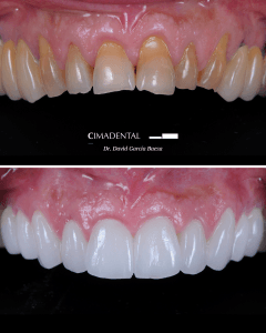Estética de mordida: caso real tratado en CIMA Dental