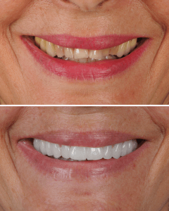 Sonrisa restaurada con implantes de carga inmediata en CIMA Dental, Madrid