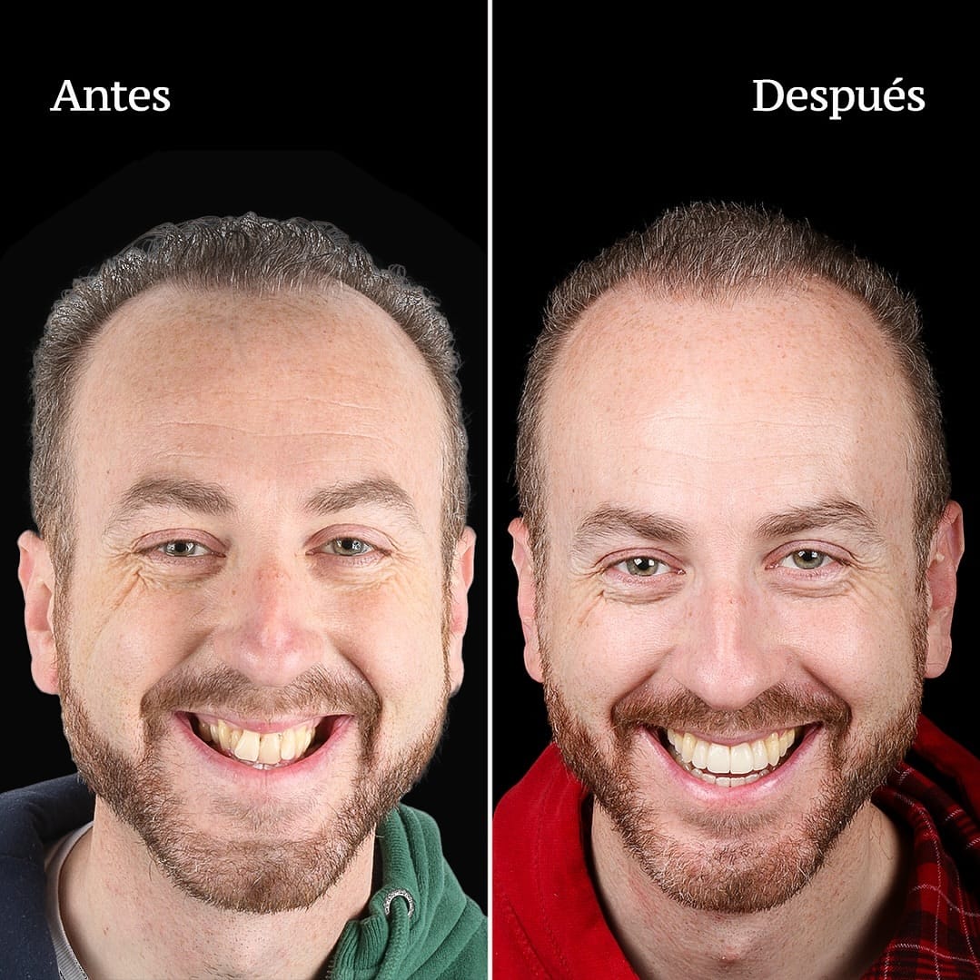 Resultado antes y despues de un caso de cirugia ortognatica tratado en CIMA Dental