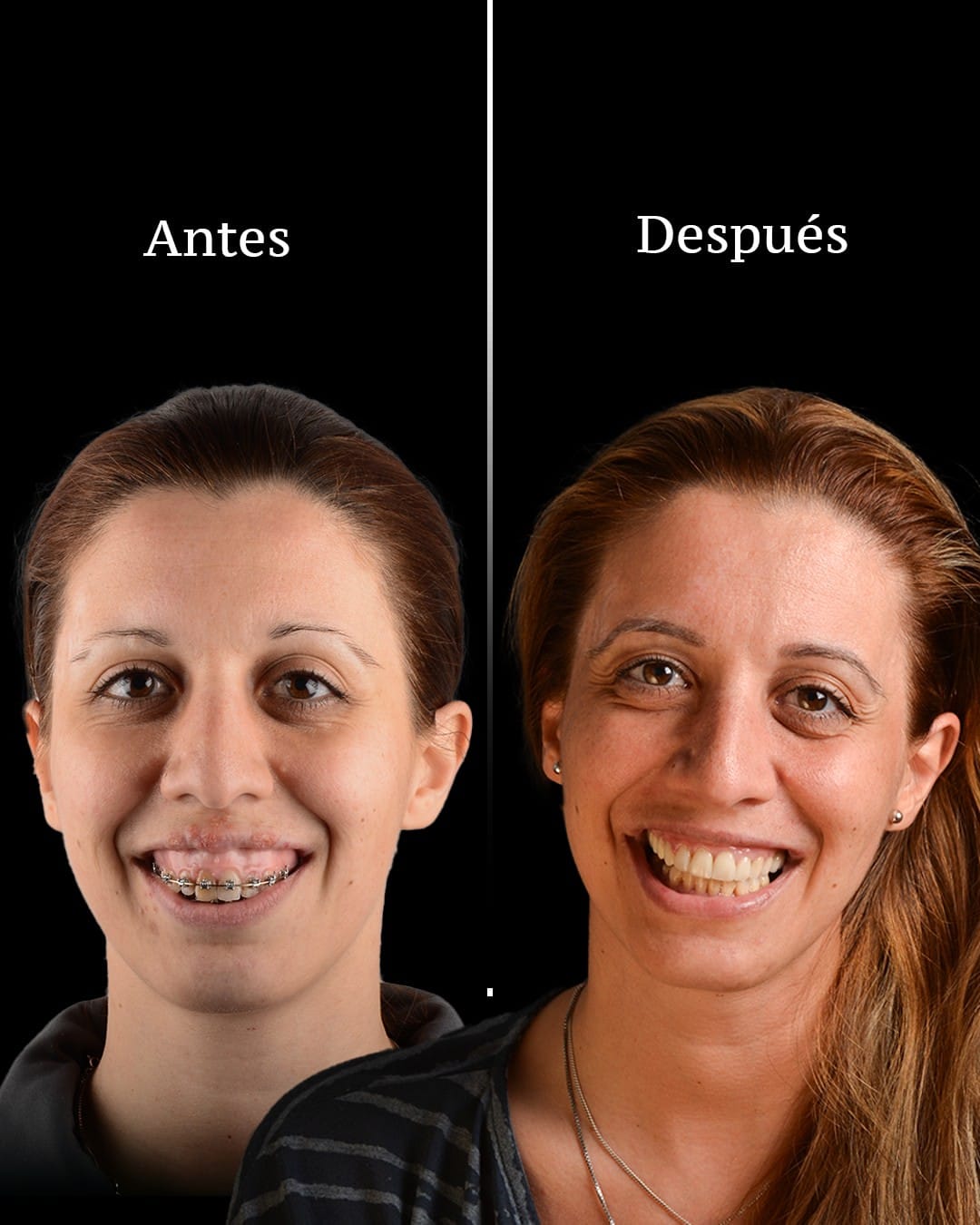 Antes y despues de un caso de ortodoncia y cirugia ortognatica tratado en CIMA Dental, Mirasierra, Madrid