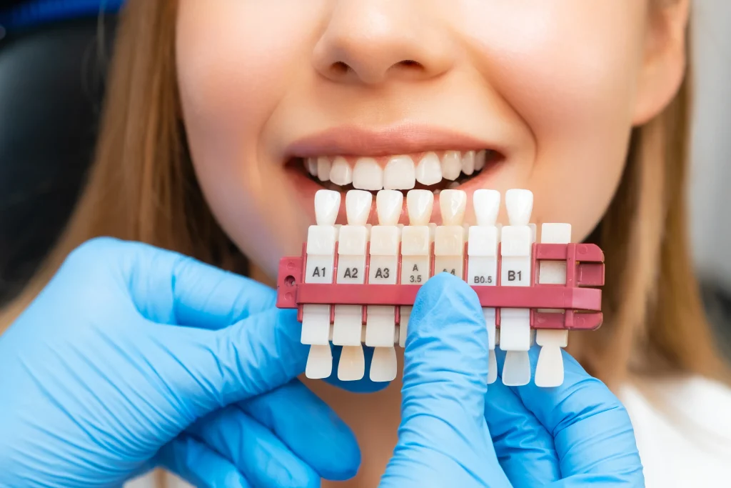 Blanqueamiento dental en casa con férulas a medida frente a blanqueamiento en clínica — CIMA Dental, Mirasierra (Madrid)