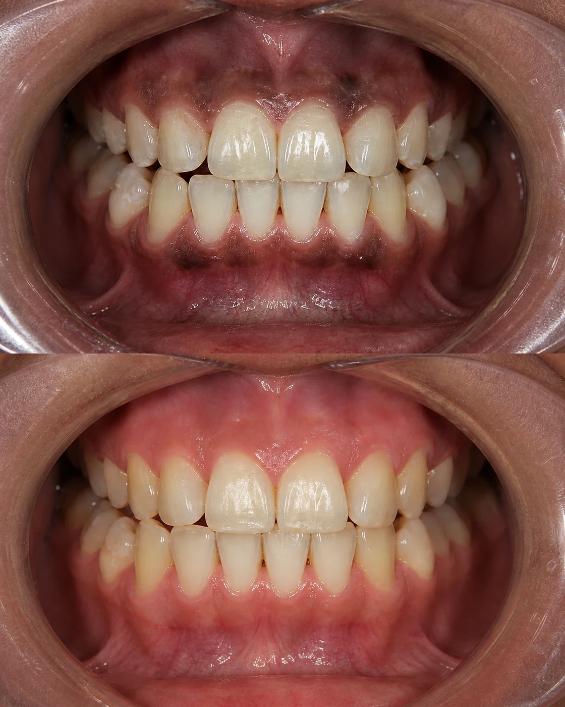 Tratamiento de blanqueamiento de encías con peeling gingival en CIMA Dental, clínica dental en Mirasierra, Madrid