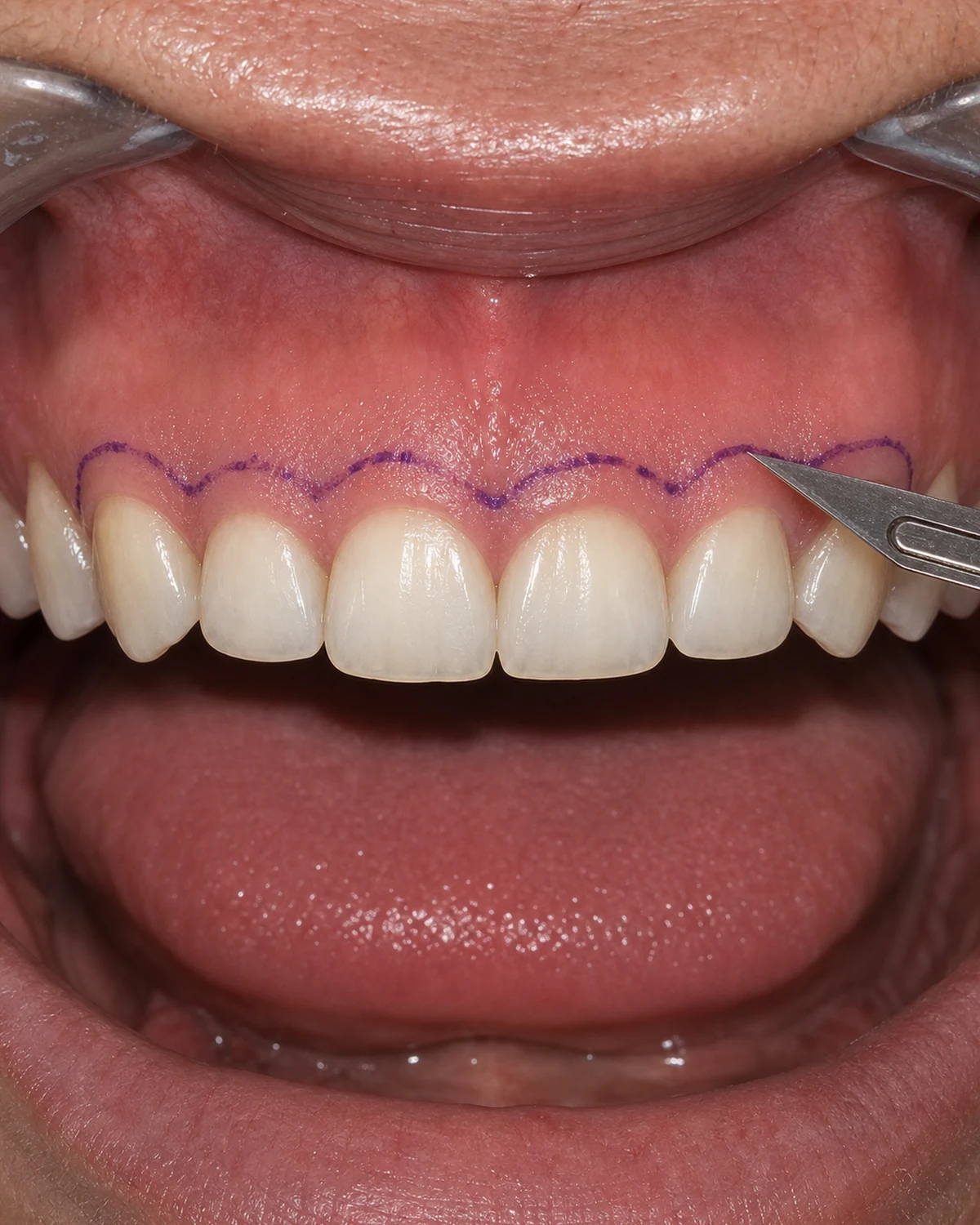 Técnica de gingivectomía: remodelado del contorno de la encía en CIMA Dental, Madrid