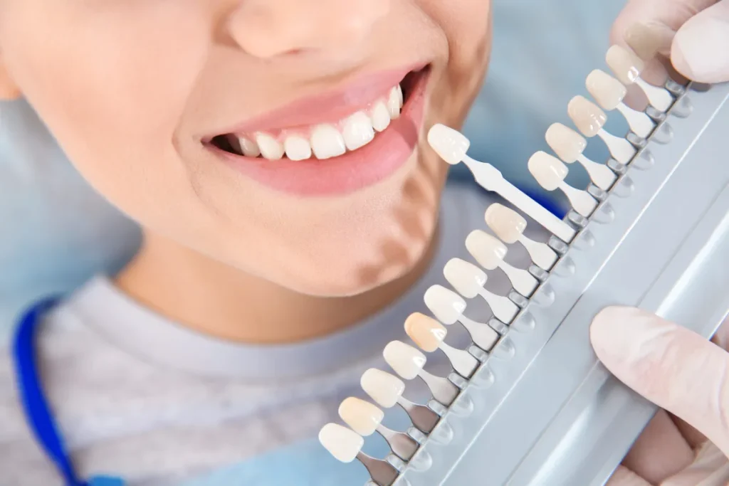 Dentista comparando el tono de los dientes con una guía de color para planificar el blanqueamiento
