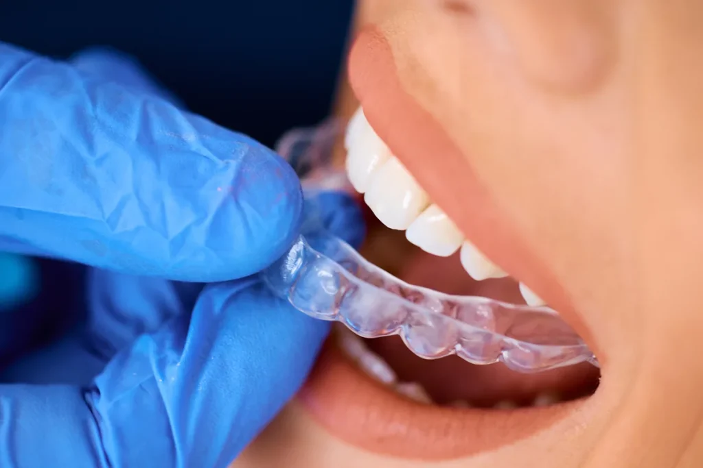 Alineador transparente de ortodoncia invisible colocándose sobre los dientes